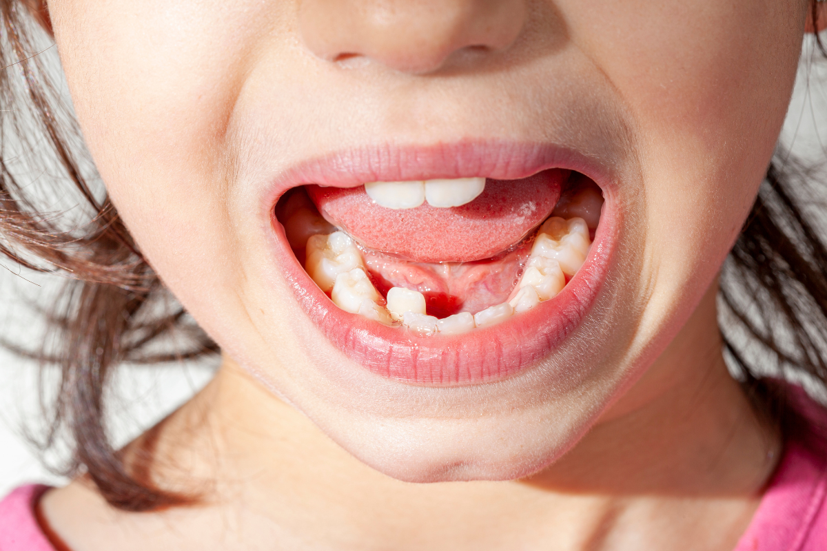 Child showing crowded lower front teeth as permanent teeth come in